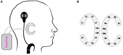 Decoding Selective Attention in Normal Hearing Listeners and Bilateral Cochlear Implant Users With Concealed Ear EEG